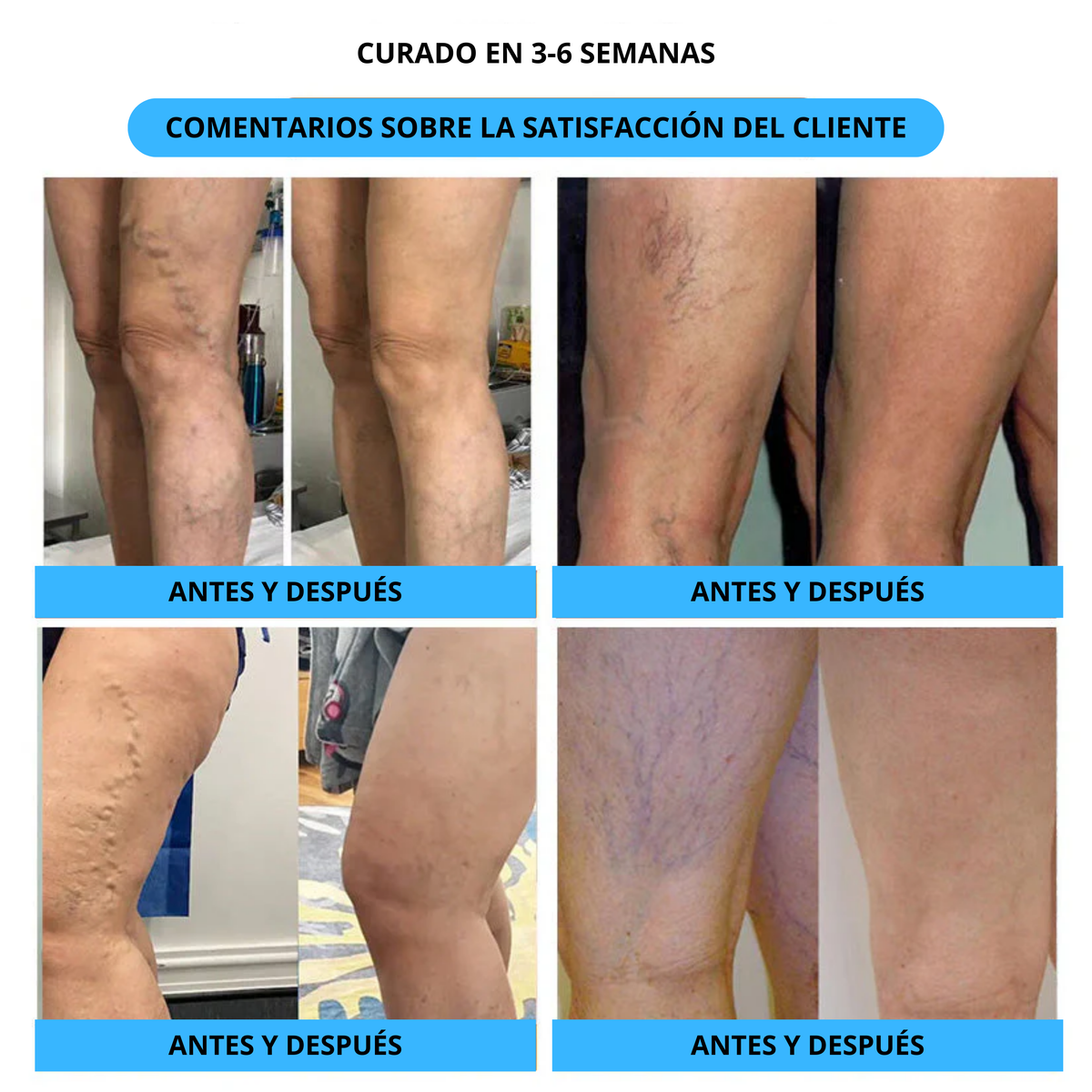 Spray Varicose Veins® 2X1🎁 - Dile adiós a las varices