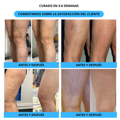 Spray Varicose Veins® 2X1🎁 - Dile adiós a las varices