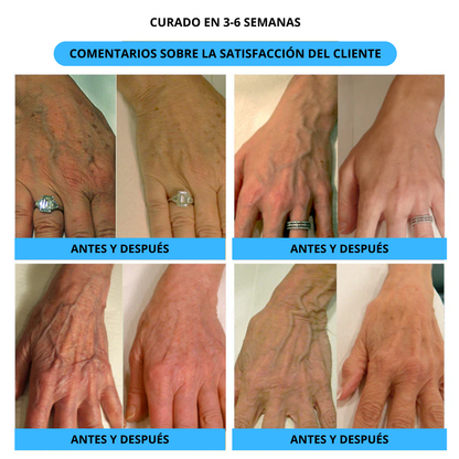 Spray Varicose Veins® 2X1🎁 - Dile adiós a las varices